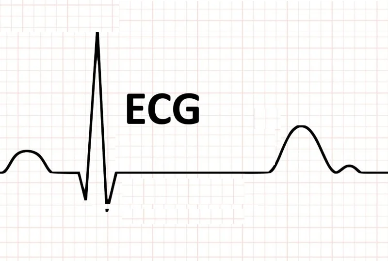 ECG